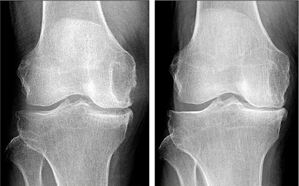 Antes y después del tratamiento de la osteoartritis con Hondrofrost. 