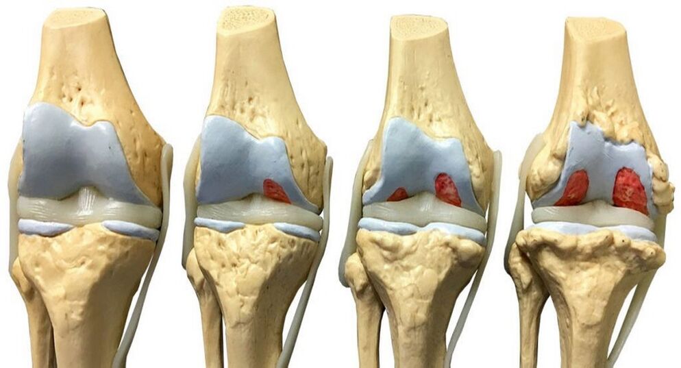 artrosis que debe tratarse con Hondrofrost