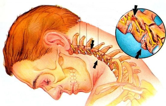 Osteocondrosis cervical