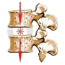 El dispositivo de la columna y las causas de la osteocondosis