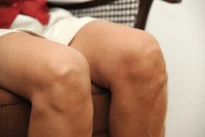 Hinchazón de la articulación de la rodilla debido a la osteoartritis.
