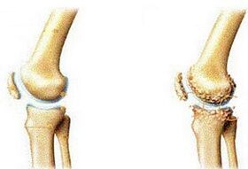 articulaciones sanas y artrosis articular