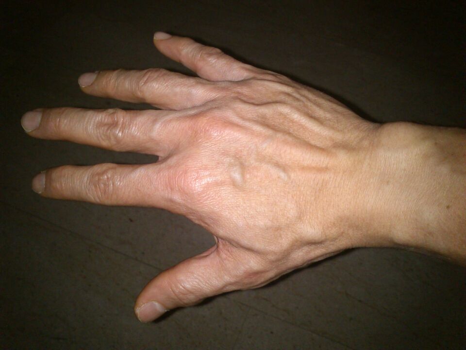 deformación ósea y dolor en las articulaciones de los dedos